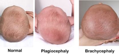 plagiocéphalie brachycéphalie